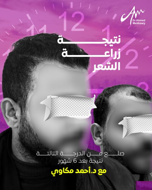 ما هي تقنية زراعة الشعر الأفضل؟ 